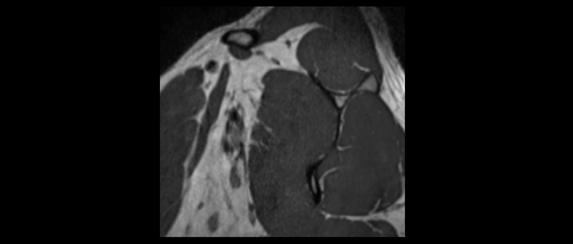 shoulder ligaments sagittal  cross sectional anatomy 3T MRI AI enhanced radiology image -img-00001-00004.webp
